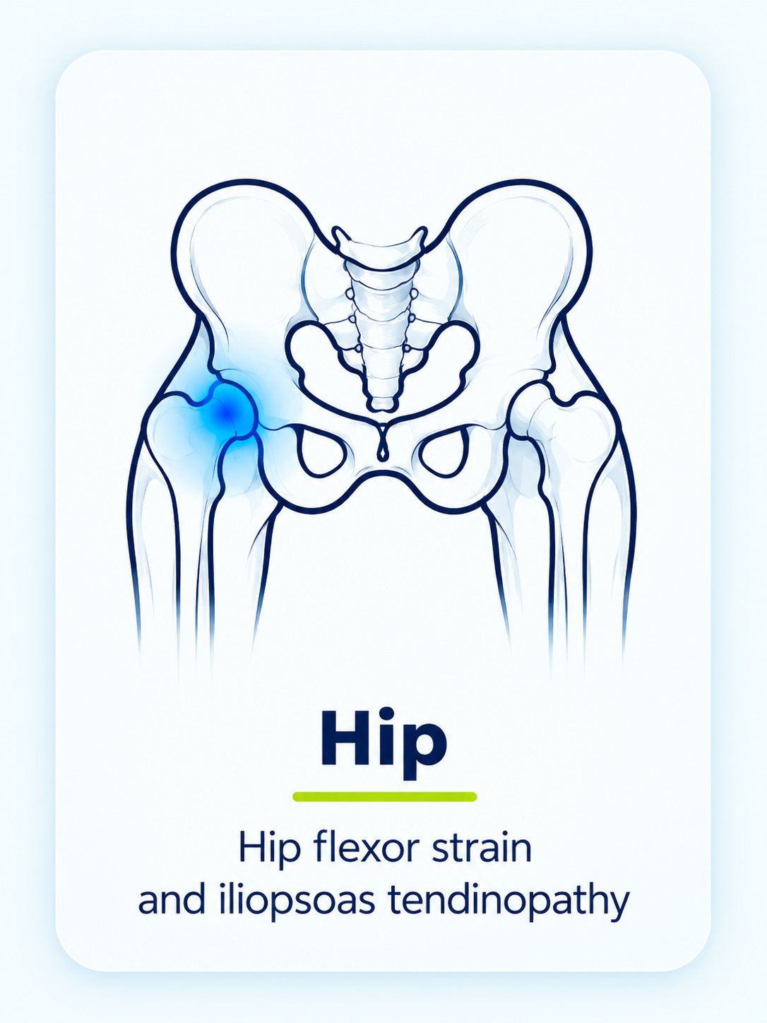 Hip flexor strain and iliopsoas tendinopathy